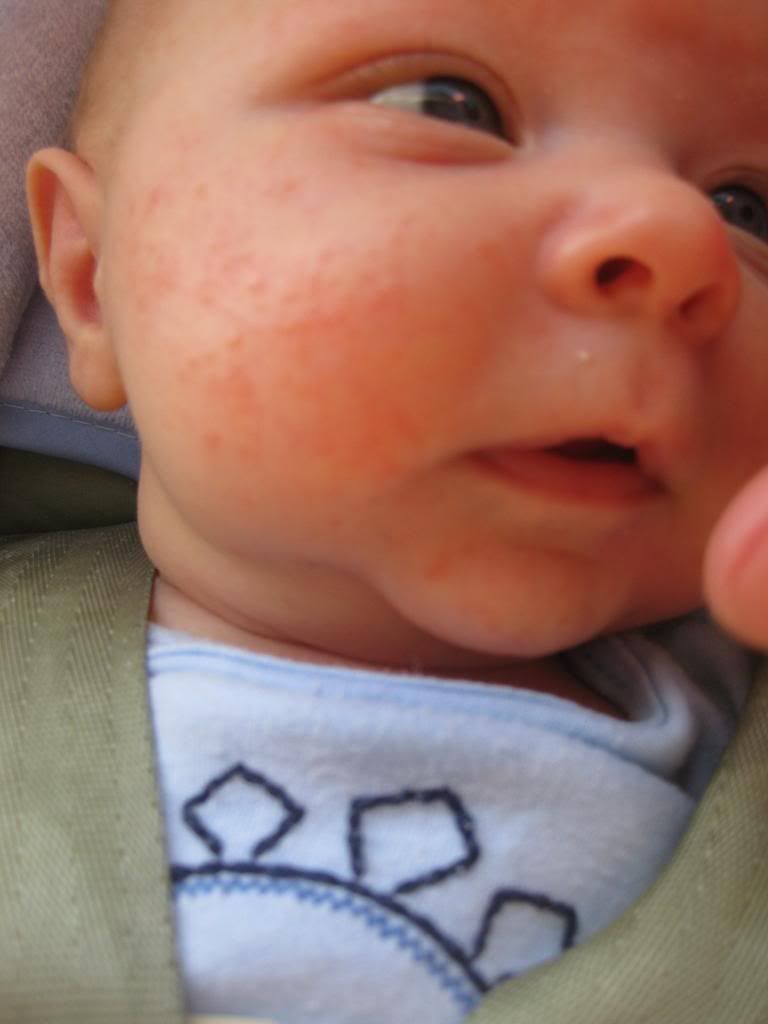 Infant Acne